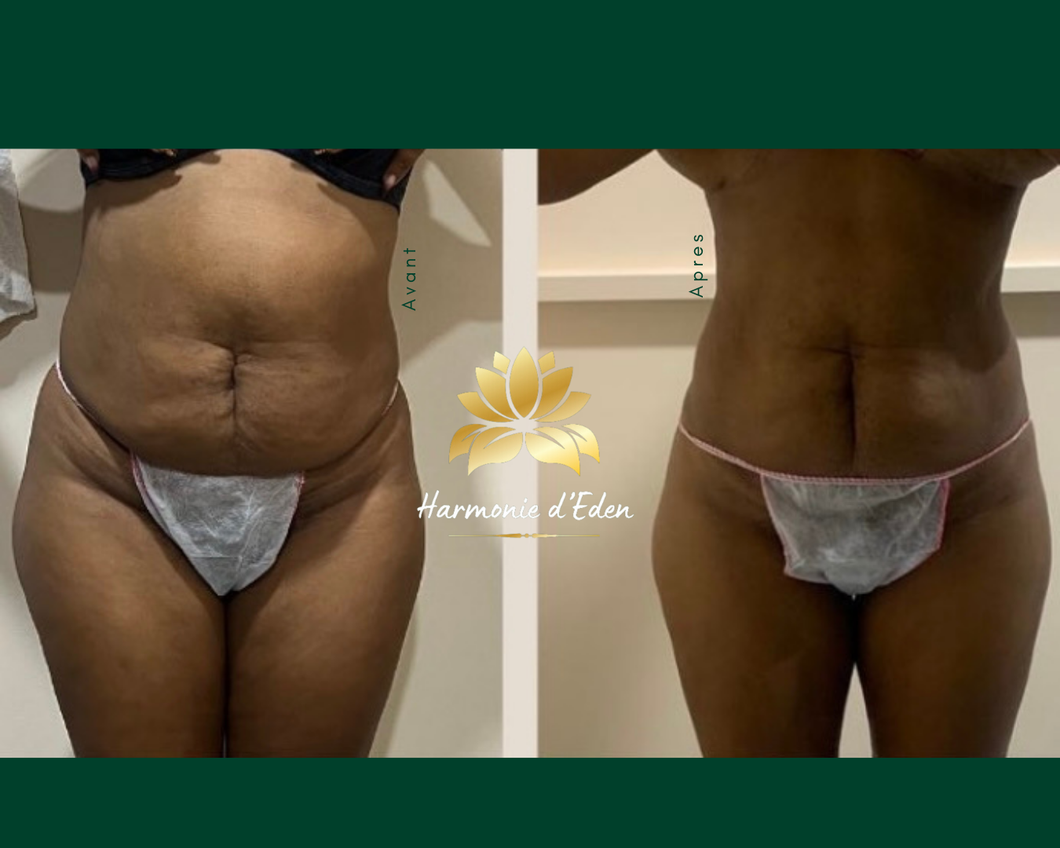 VENTRE - 10 séances lipocavitation/ radiofrequence + 1 crème offerte